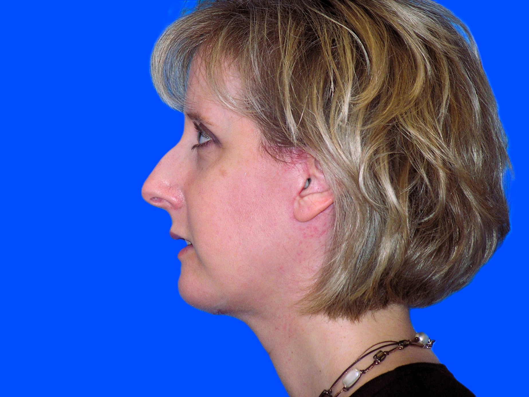 After Image: Patient Case #0126 - left-side