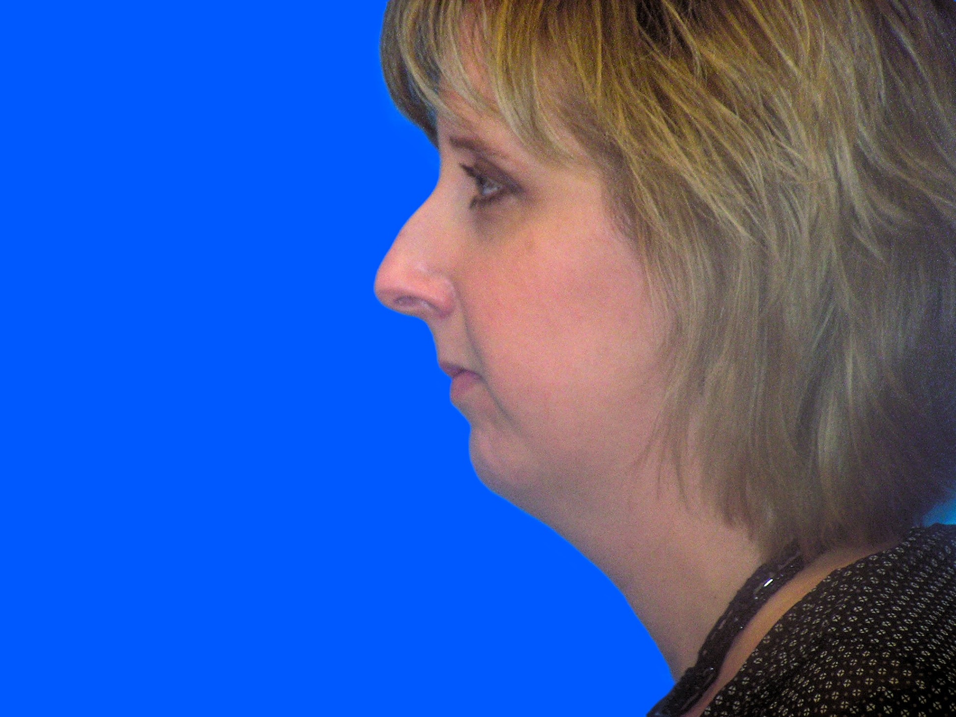 Before Image: Patient Case #0126 - left-side