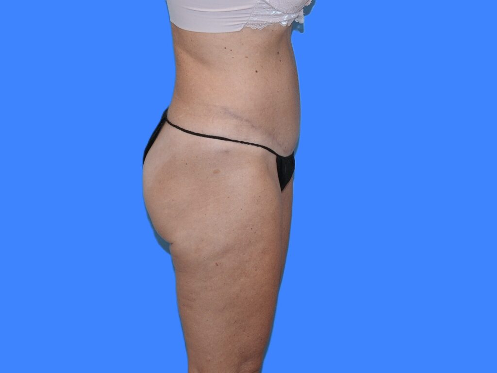 After Image: Patient Case #0127 - right-side
