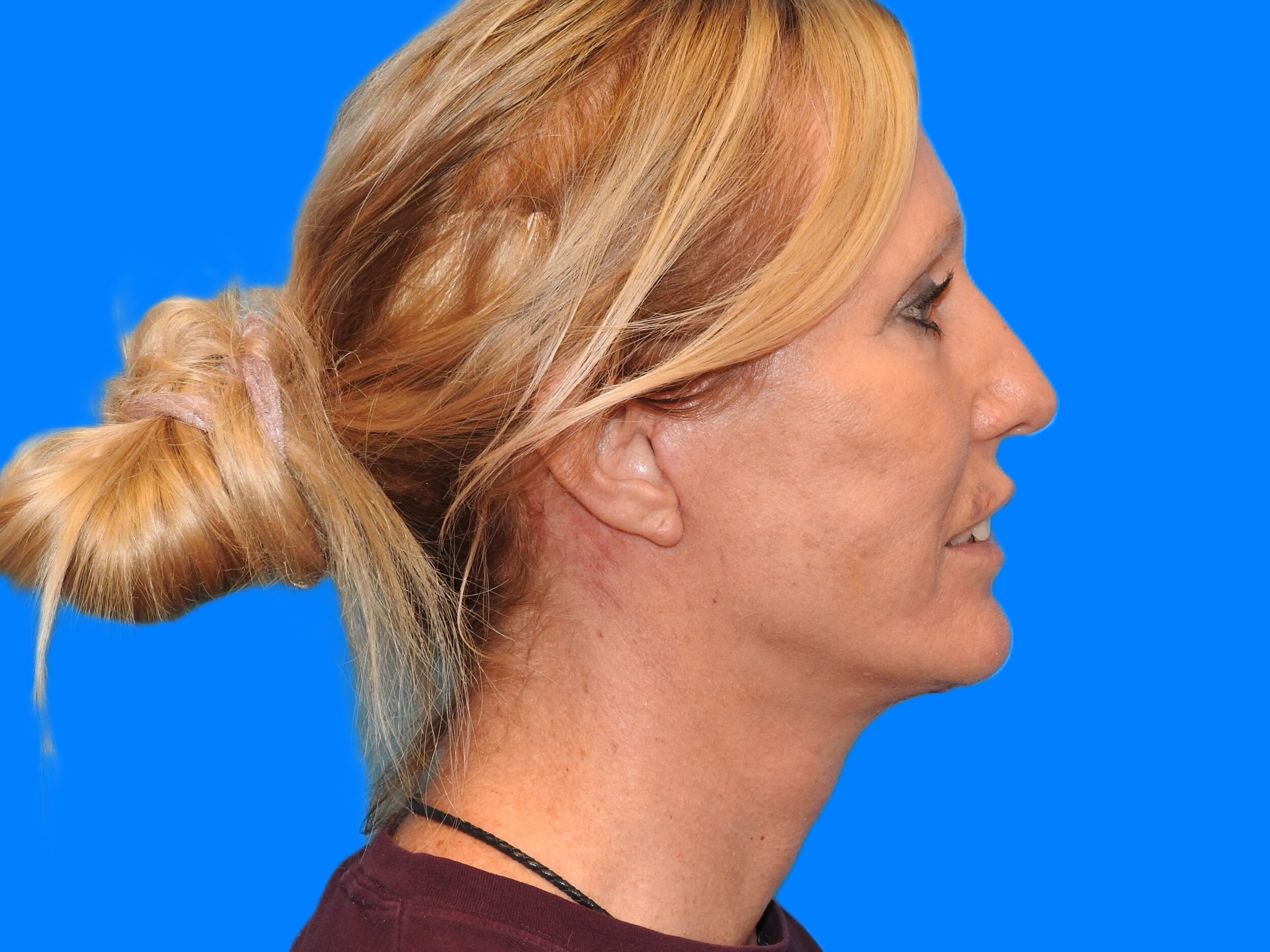 After Image: Patient Case #0127 - right-side