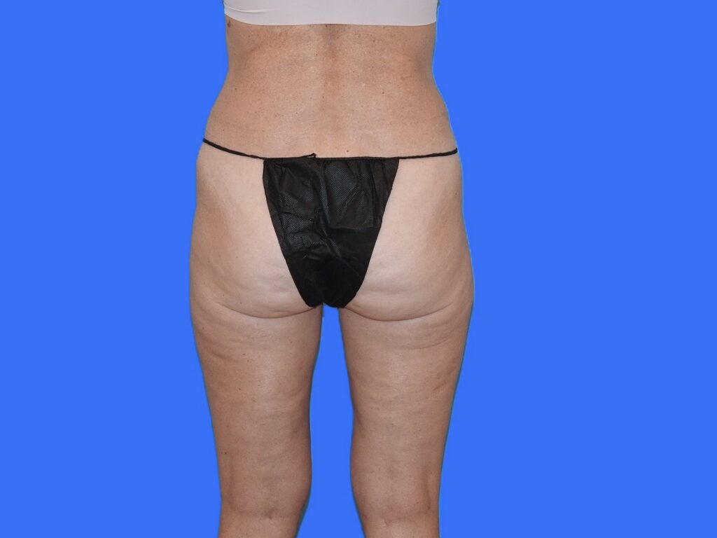 After Image: Patient Case #0127 - back