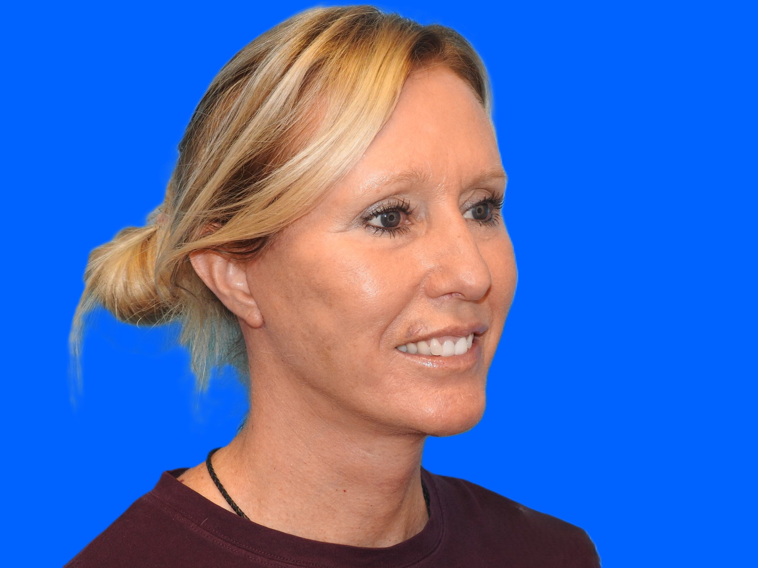 After Image: Patient Case #0127 - right-front-oblique