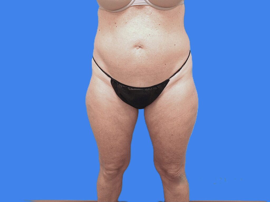 Before Image: Patient Case #0127 - front