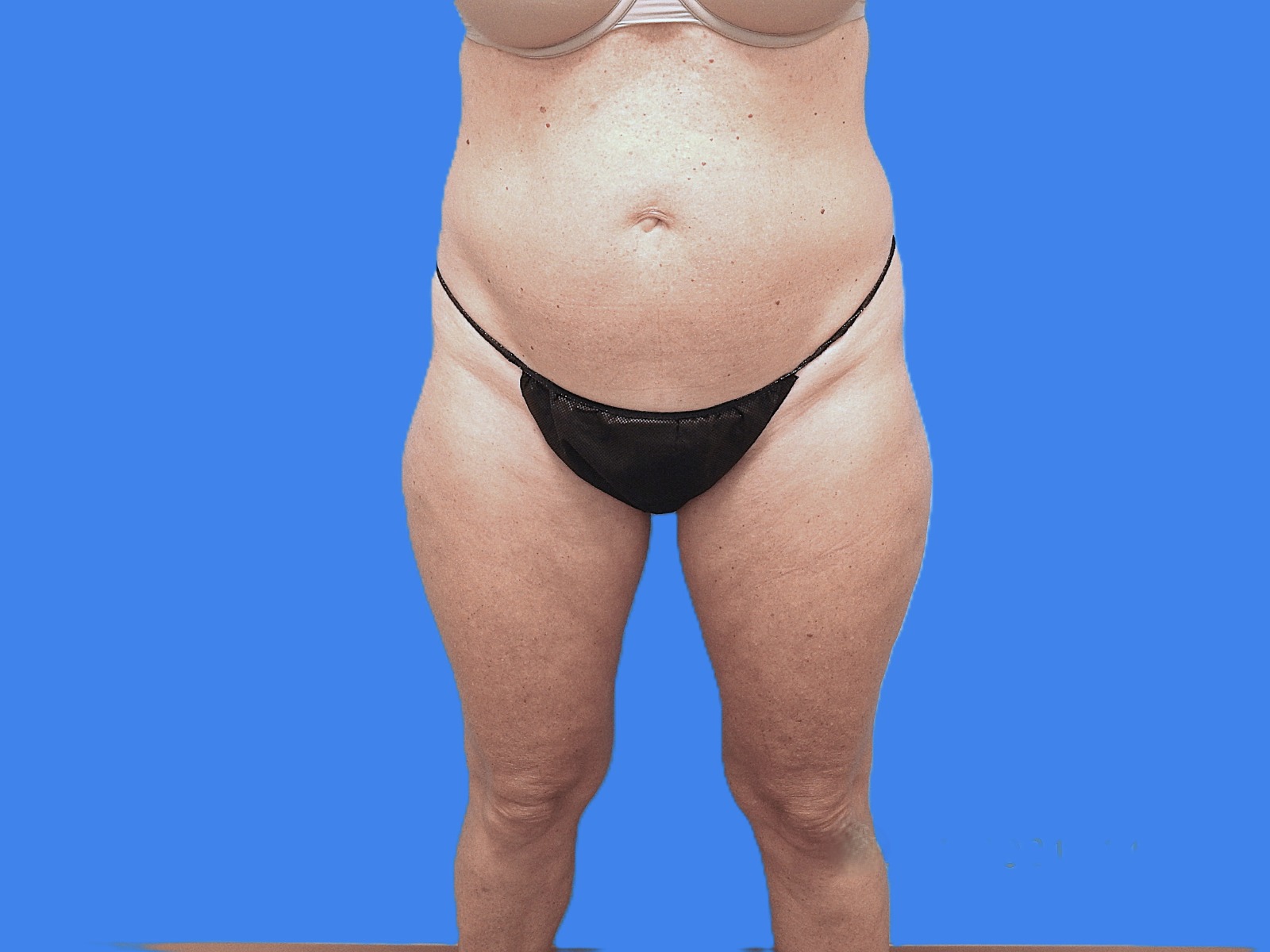 Before Image: Patient Case #0127 - front