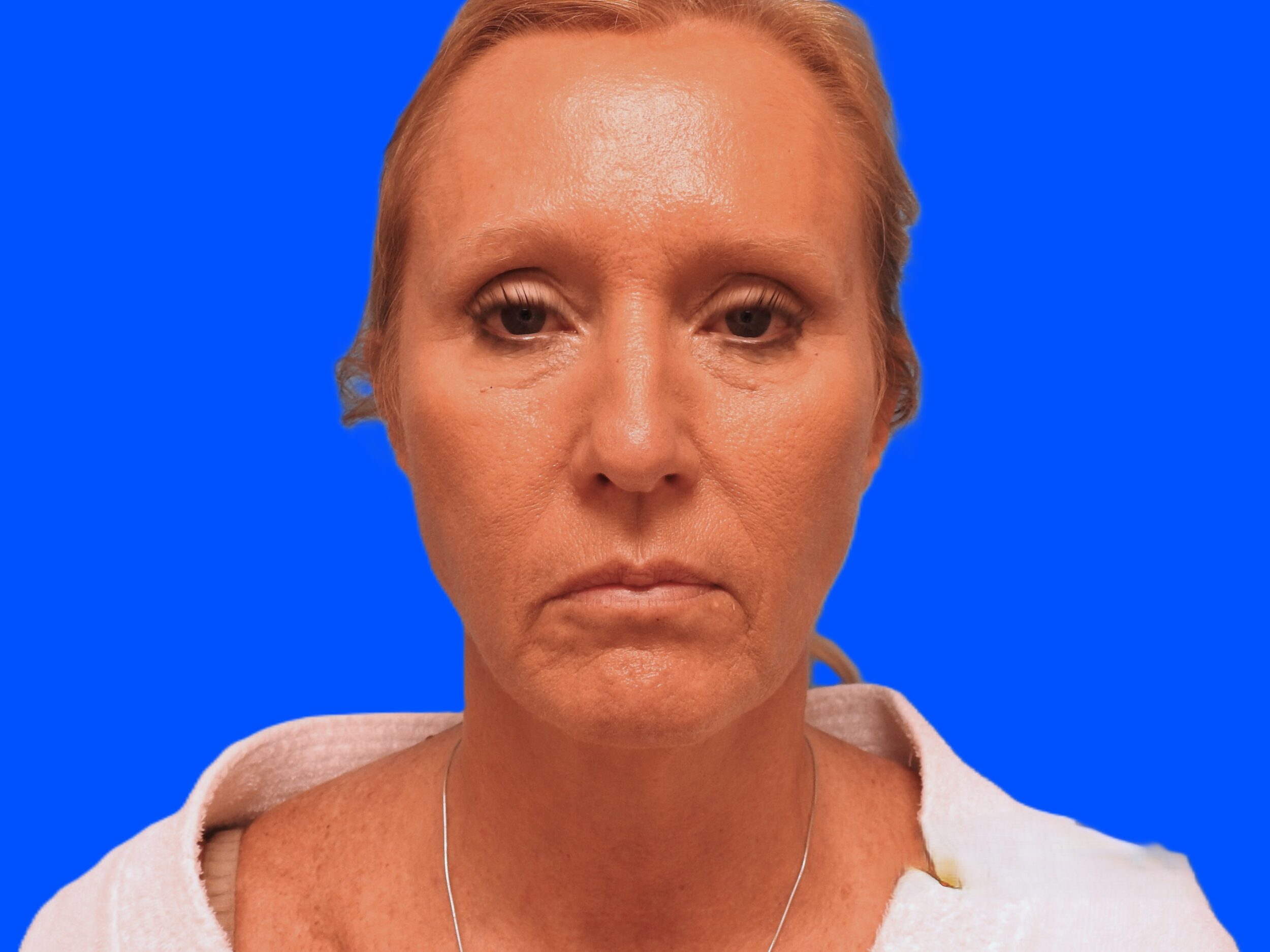 Before Image: Patient Case #0127 - front