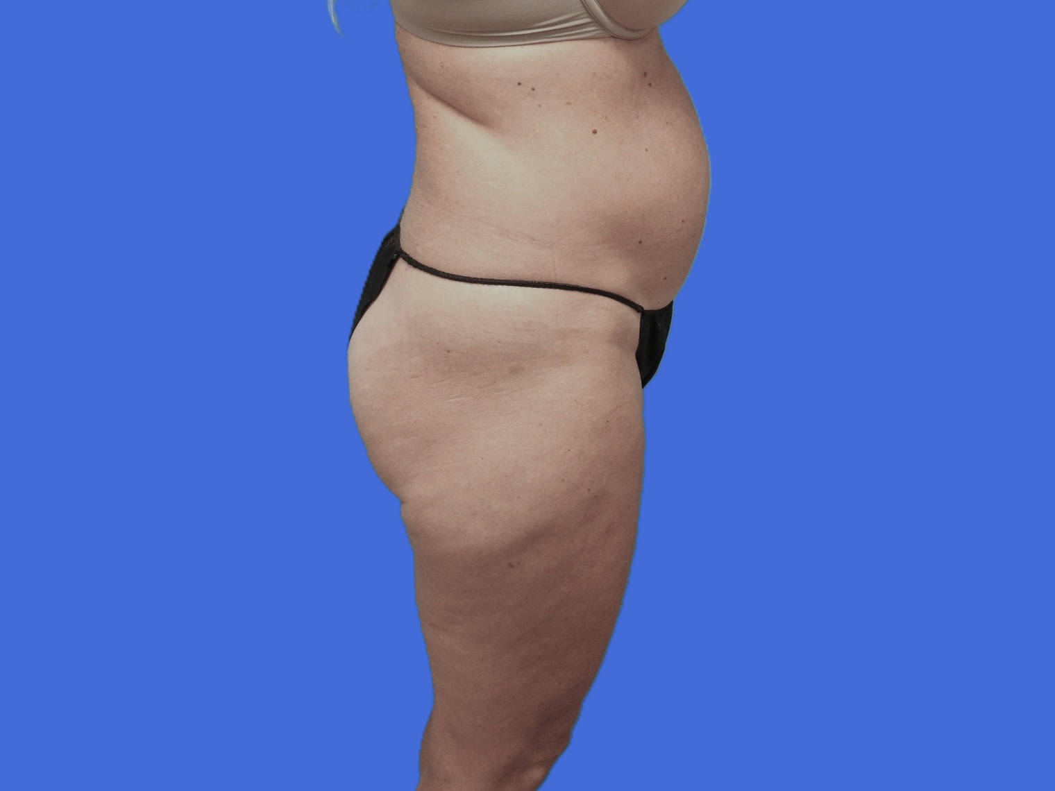 Before Image: Patient Case #0127 - right-side