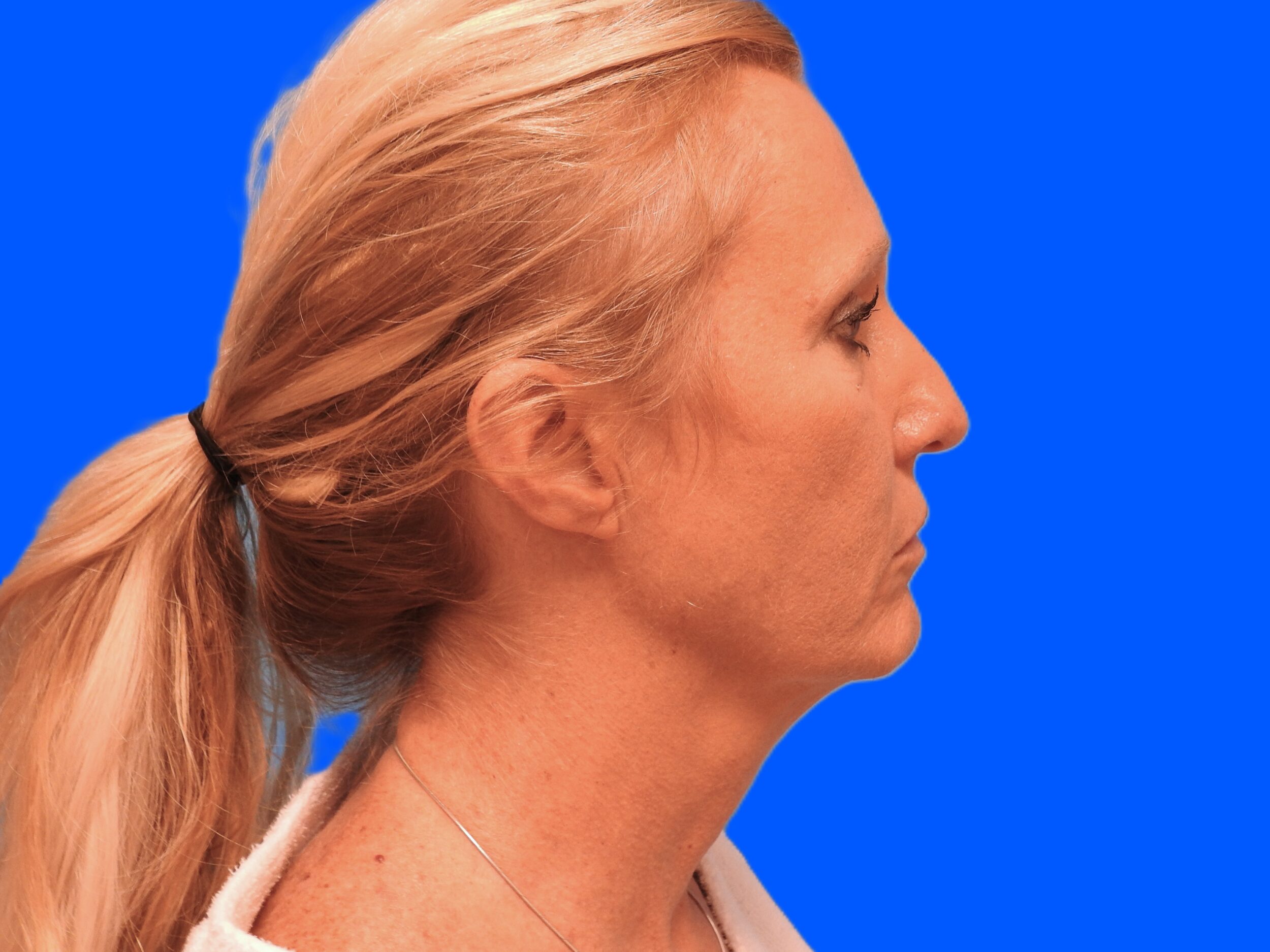 Before Image: Patient Case #0127 - right-side