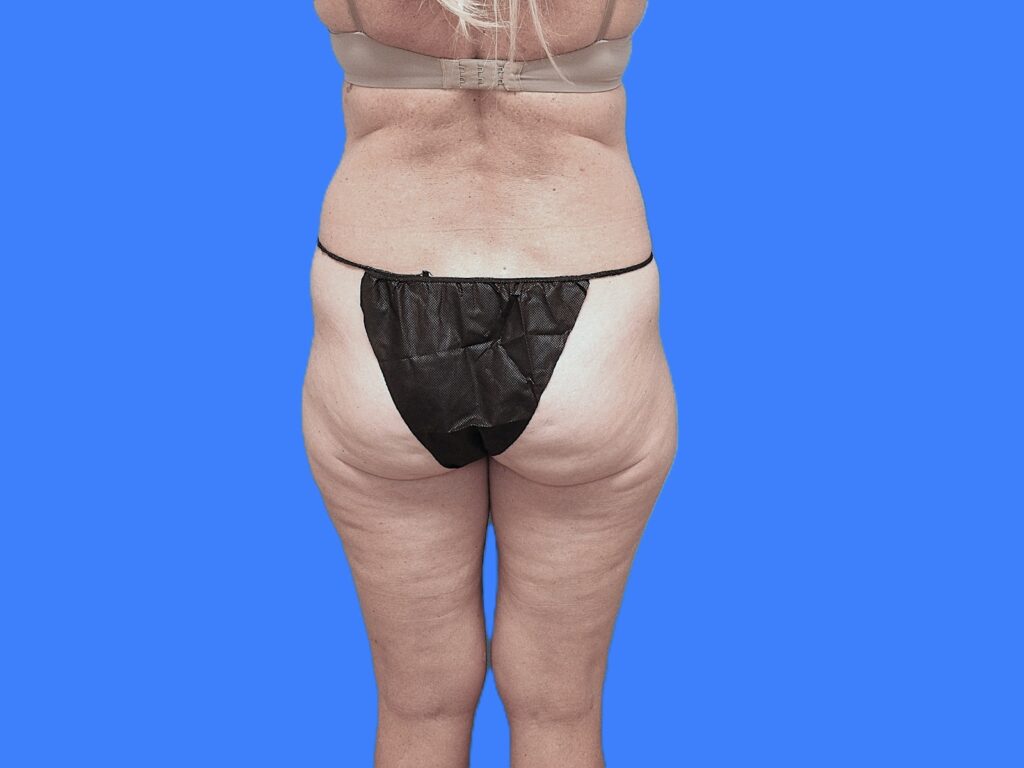 Before Image: Patient Case #0127 - back