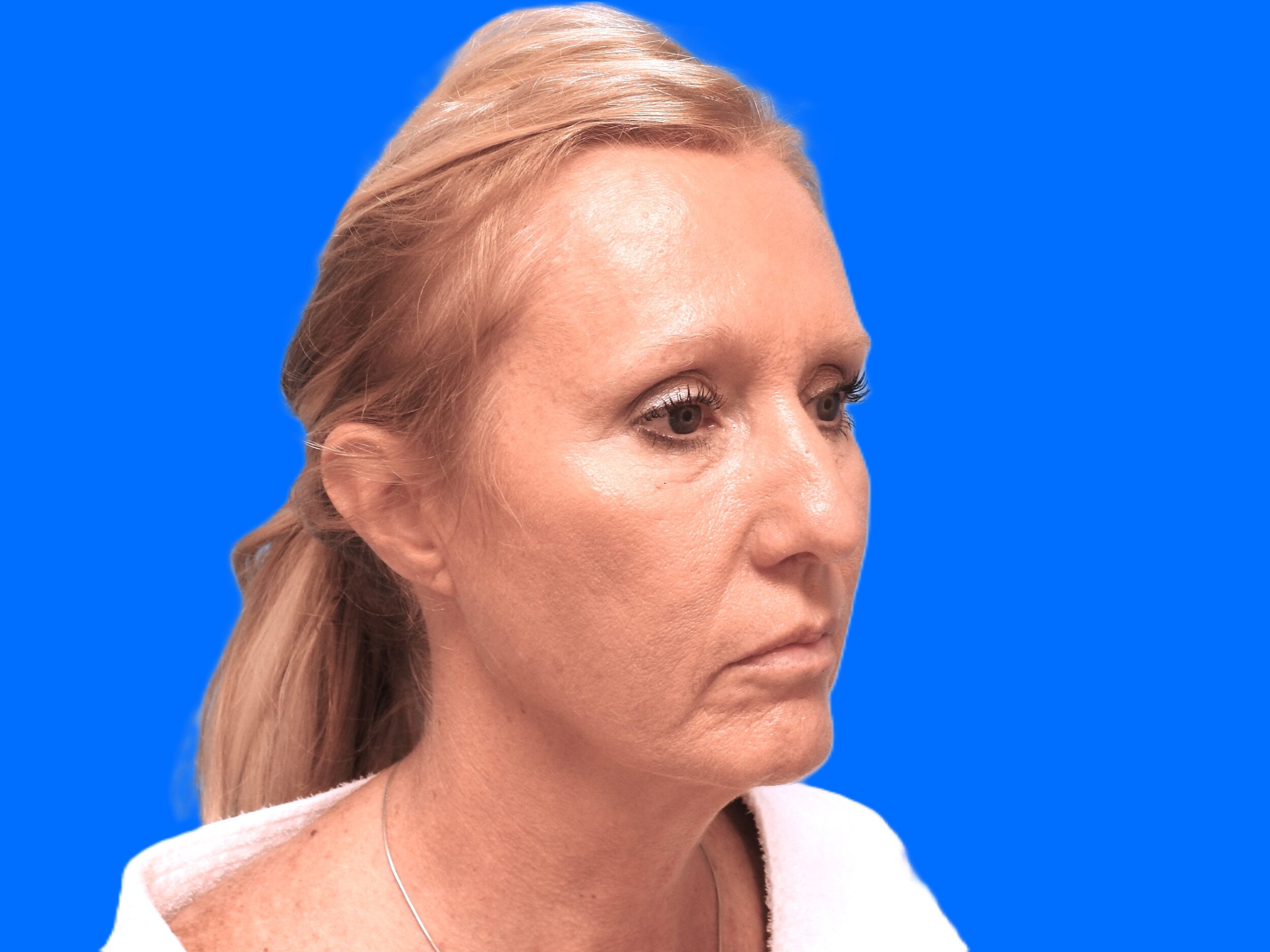 Before Image: Patient Case #0127 - right-front-oblique