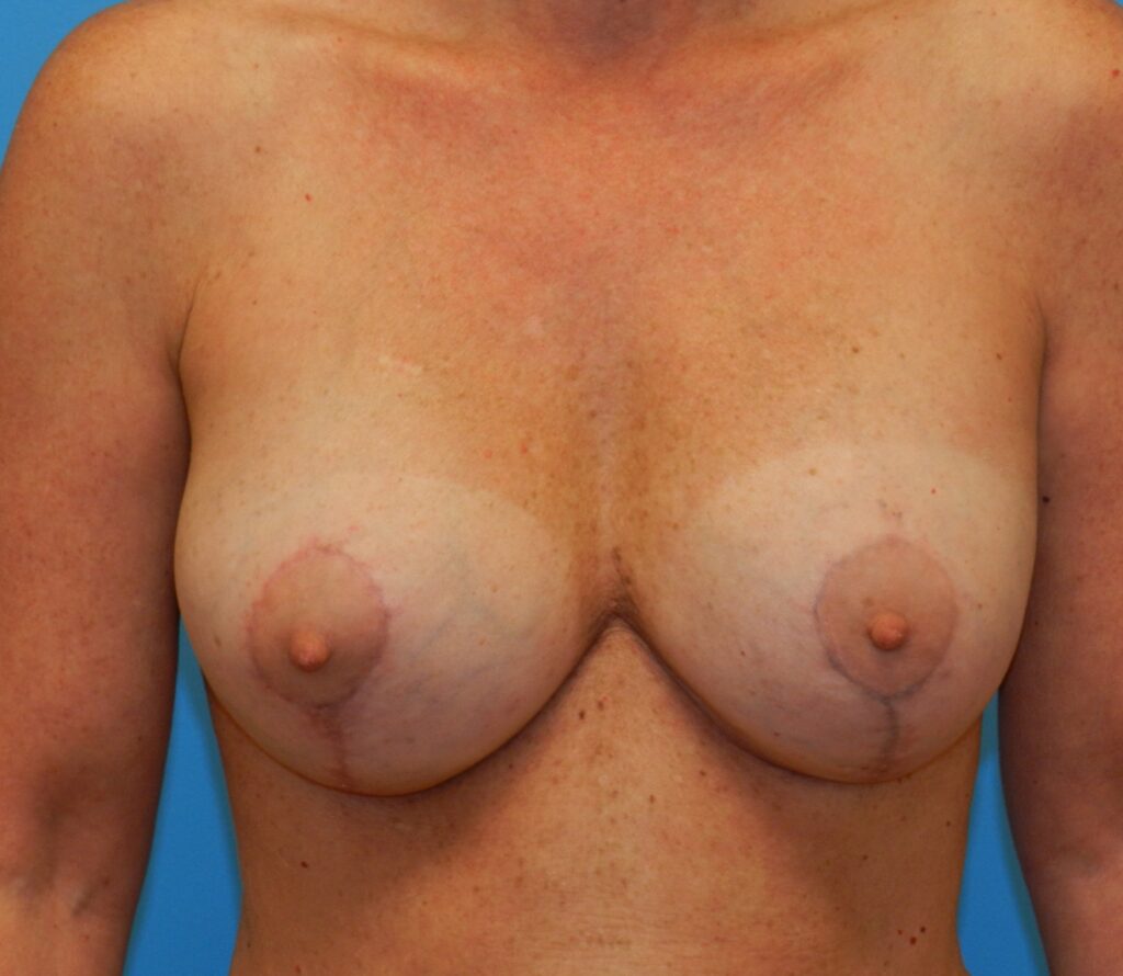 After Image: Patient Case #0128 - front