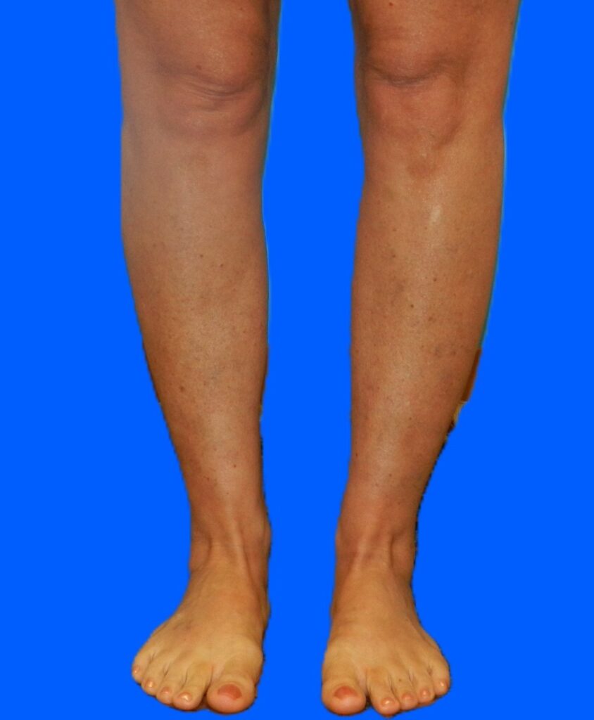 After Image: Patient Case #0128 - front