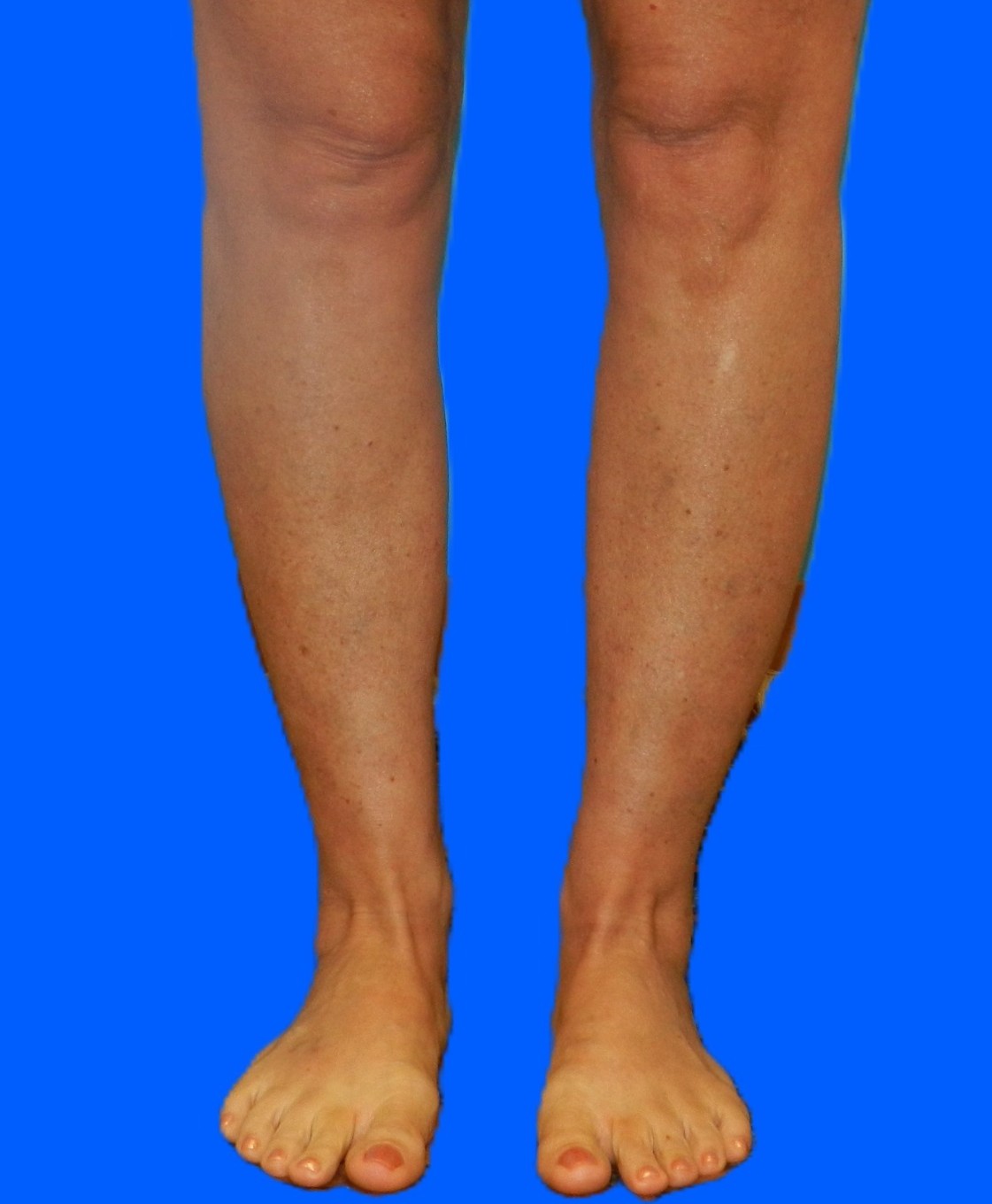 After Image: Patient Case #0128 - front