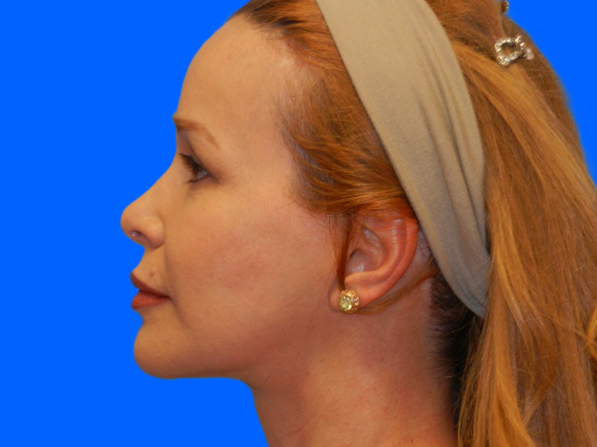 After Image: Patient Case #0128 - left-side