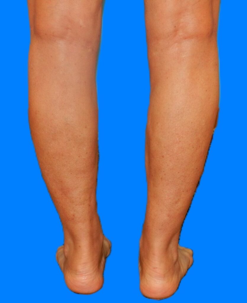 After Image: Patient Case #0128 - back
