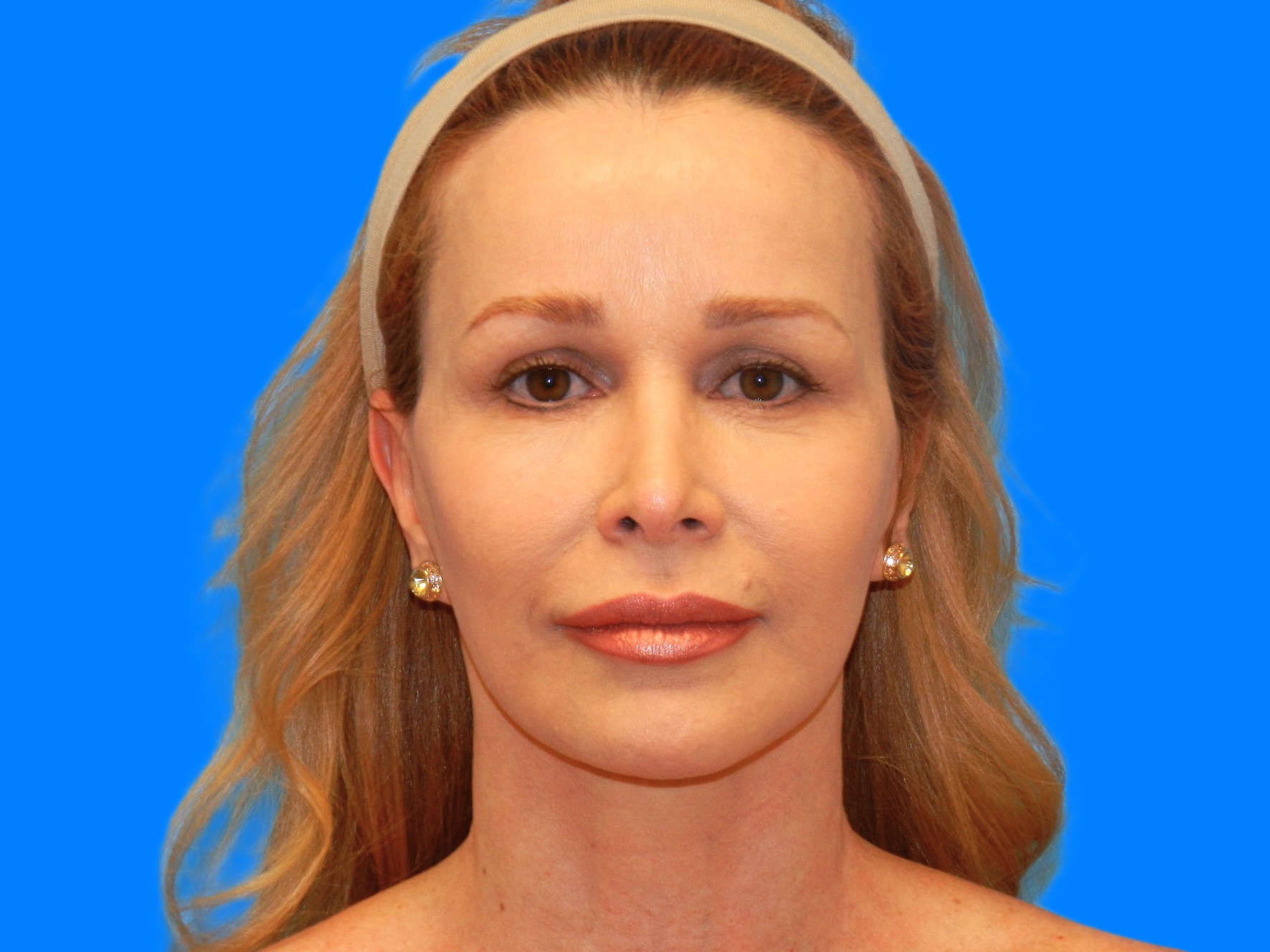 After Image: Patient Case #0128 - front