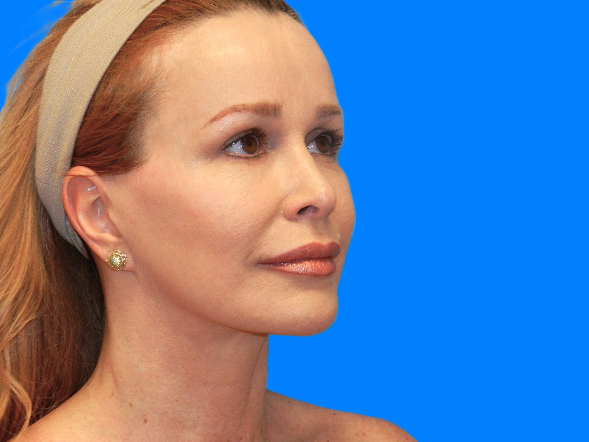 After Image: Patient Case #0128 - right-front-oblique