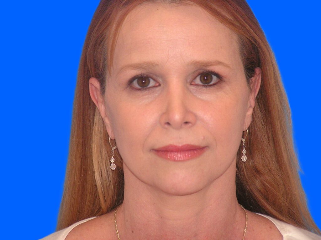 Before Image: Patient Case #0128 - front