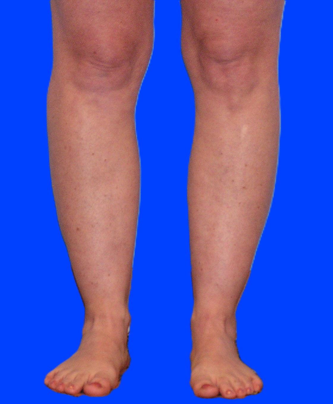 Before Image: Patient Case #0128 - front