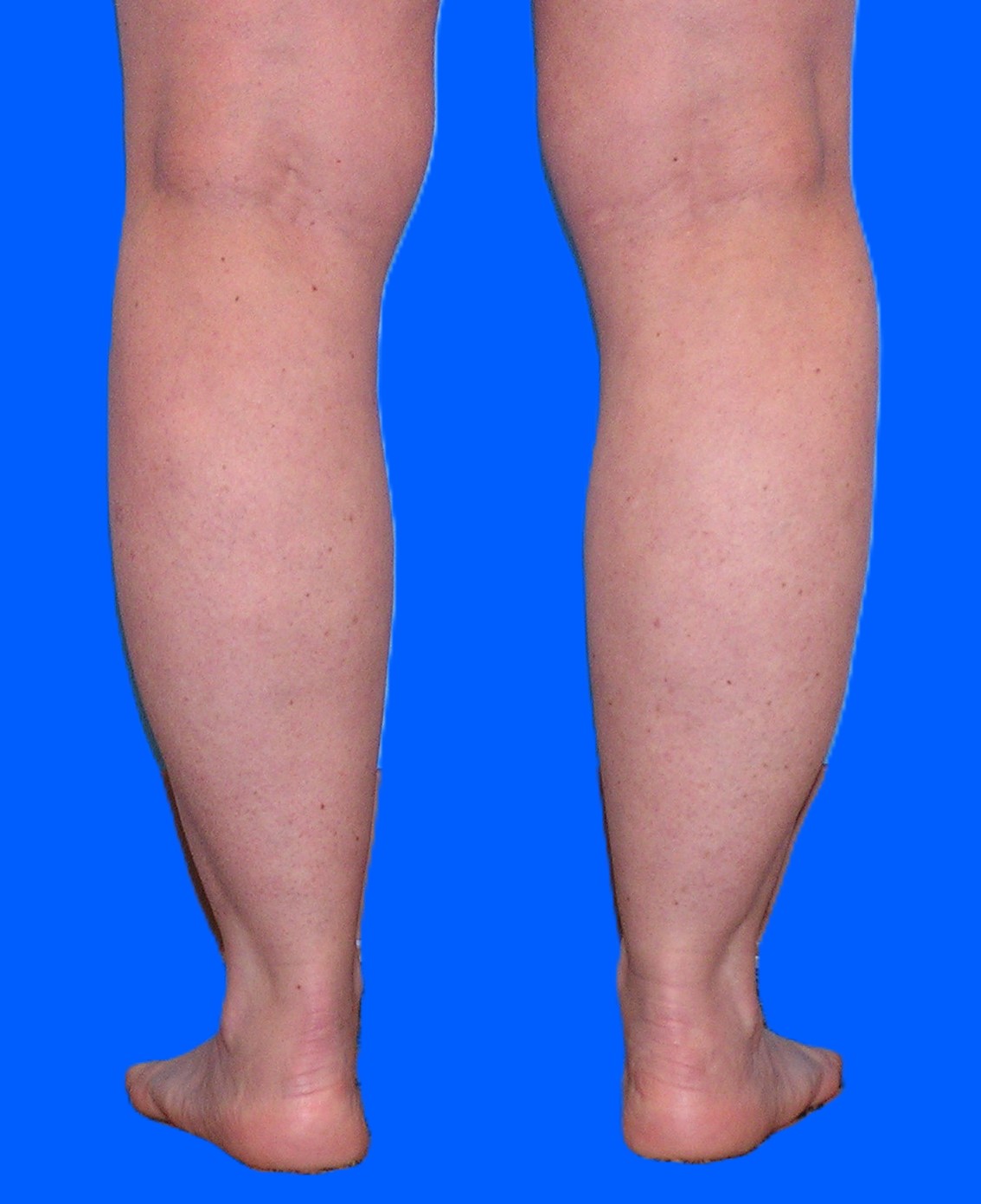 Before Image: Patient Case #0128 - back