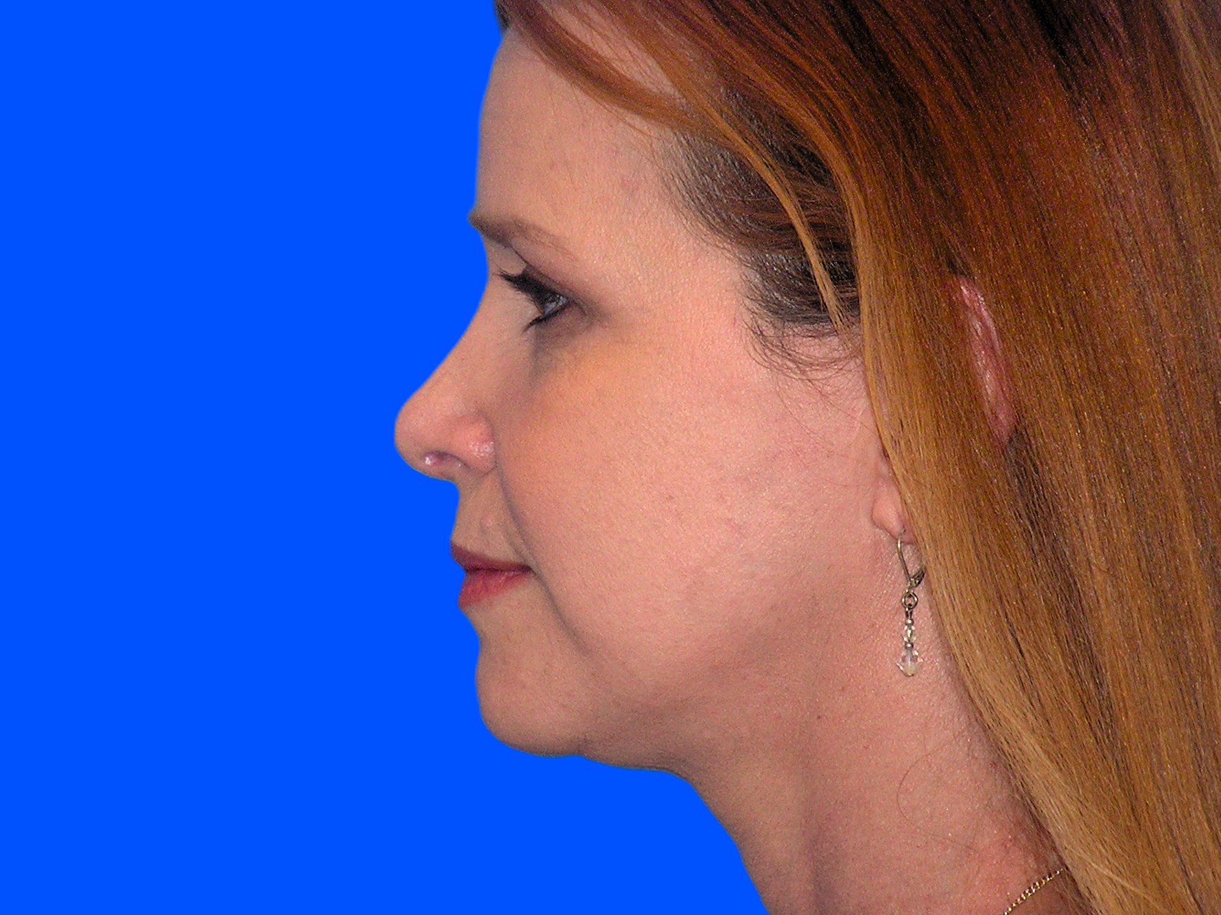 Before Image: Patient Case #0128 - left-side