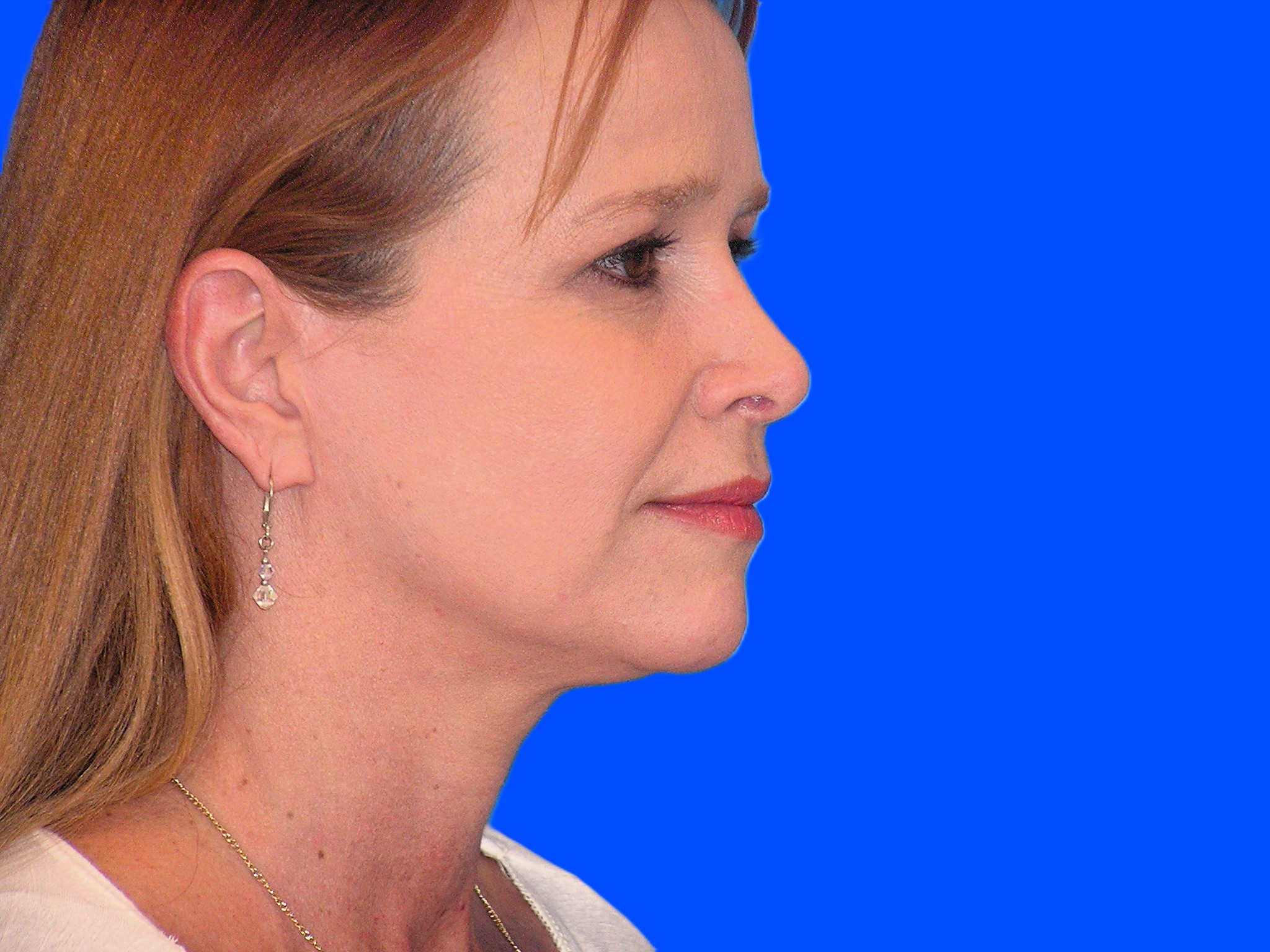 Before Image: Patient Case #0128 - right-front-oblique