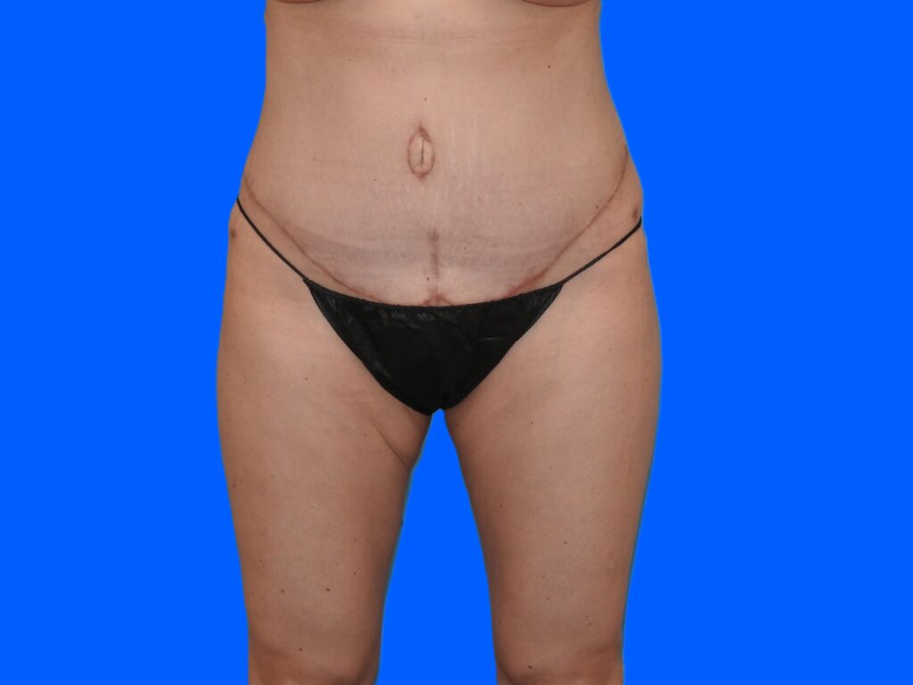 After Image: Patient Case #0129 - front