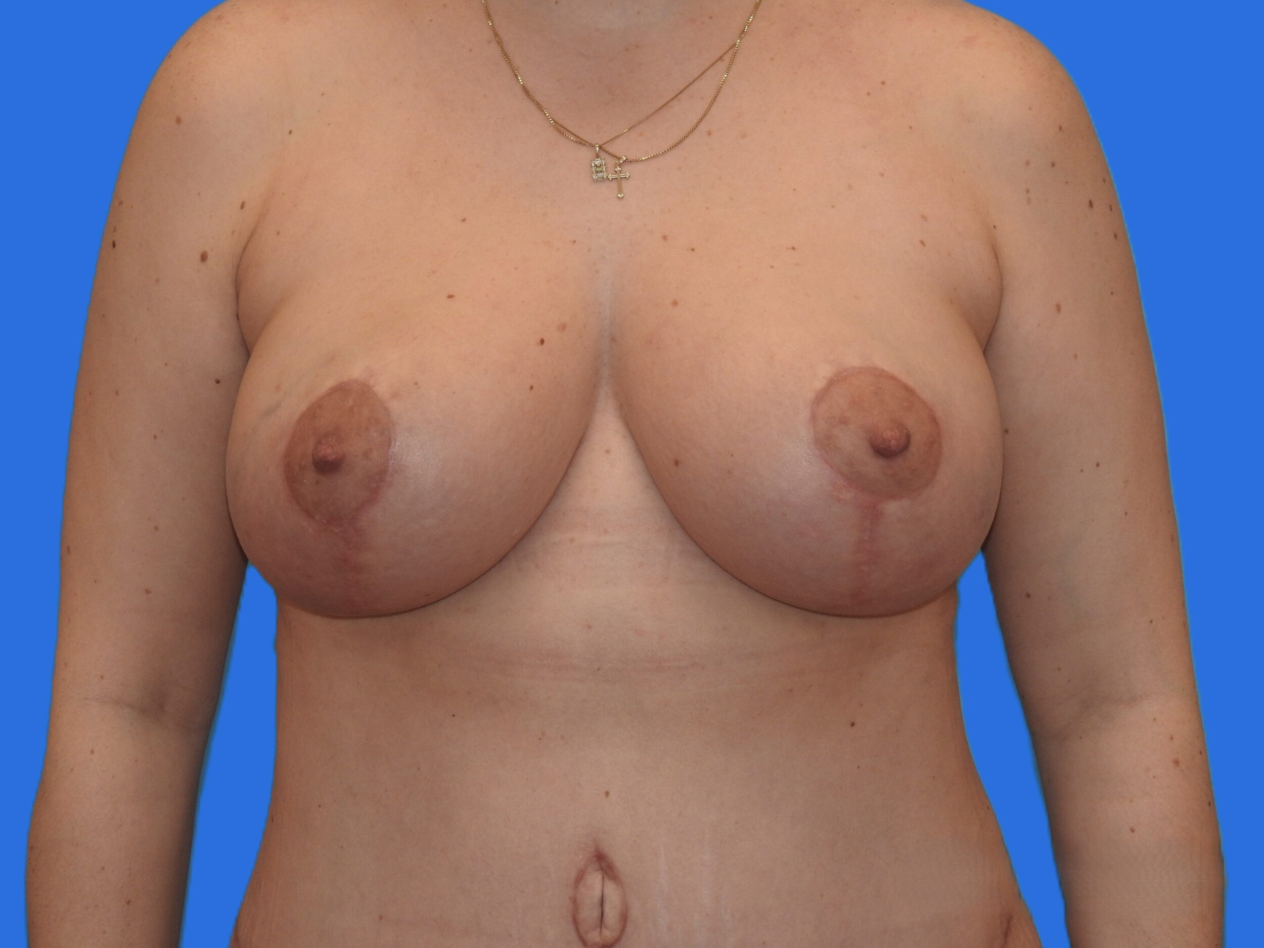 After Image: Patient Case #0129 - front