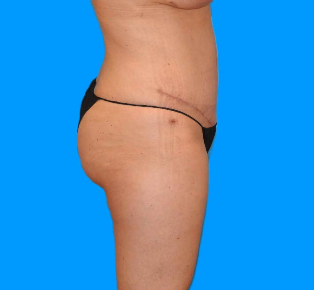 After Image: Patient Case #0129 - right-side