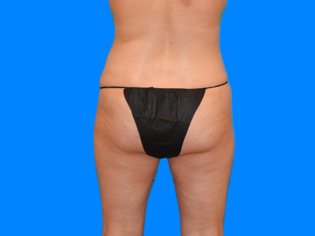 After Image: Patient Case #0129 - back