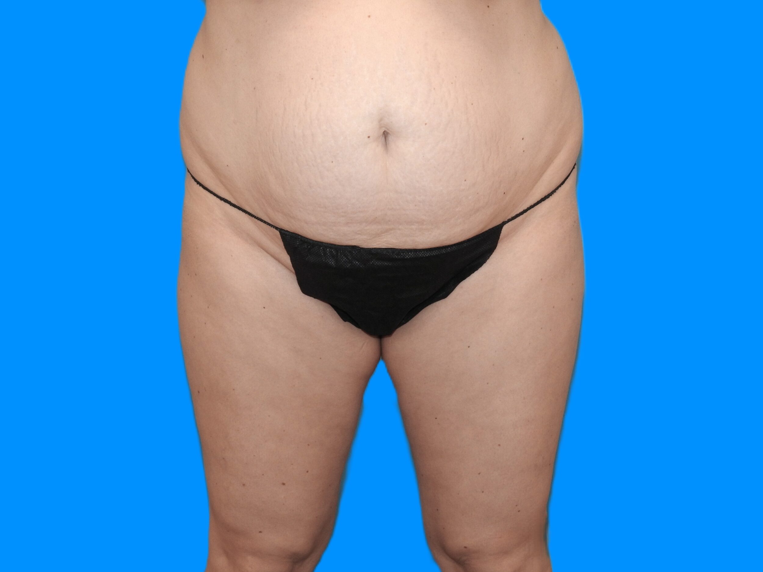 Before Image: Patient Case #0129 - front