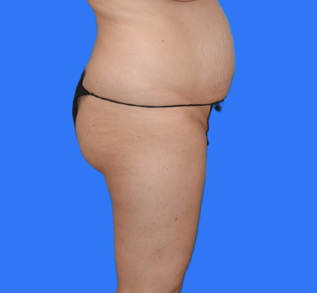 Before Image: Patient Case #0129 - right-side