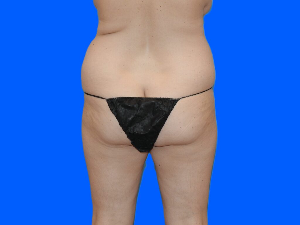 Before Image: Patient Case #0129 - back