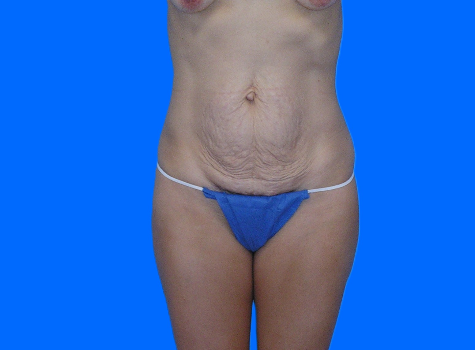 Before Image: Patient Case #0130 - front