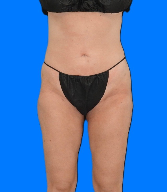 After Image: Patient Case #0131 - front