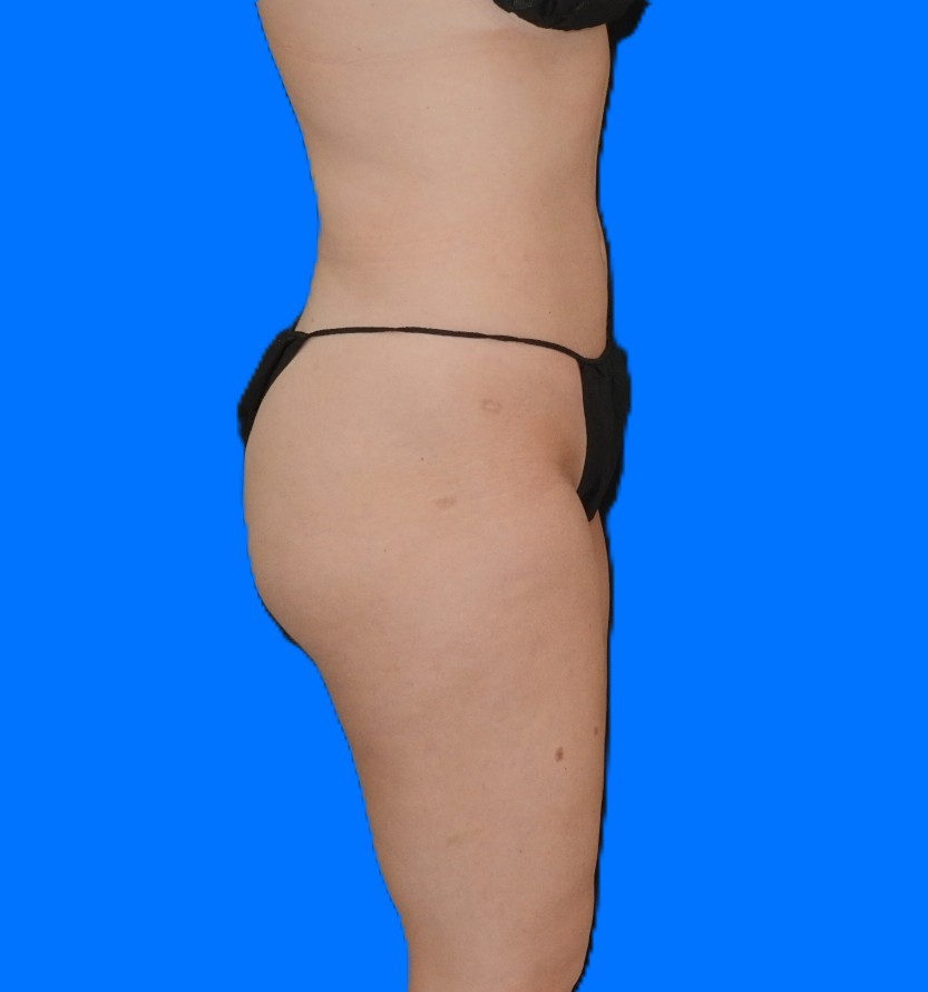 After Image: Patient Case #0131 - right-side