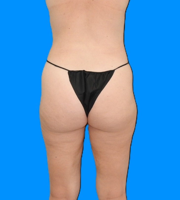 After Image: Patient Case #0131 - back