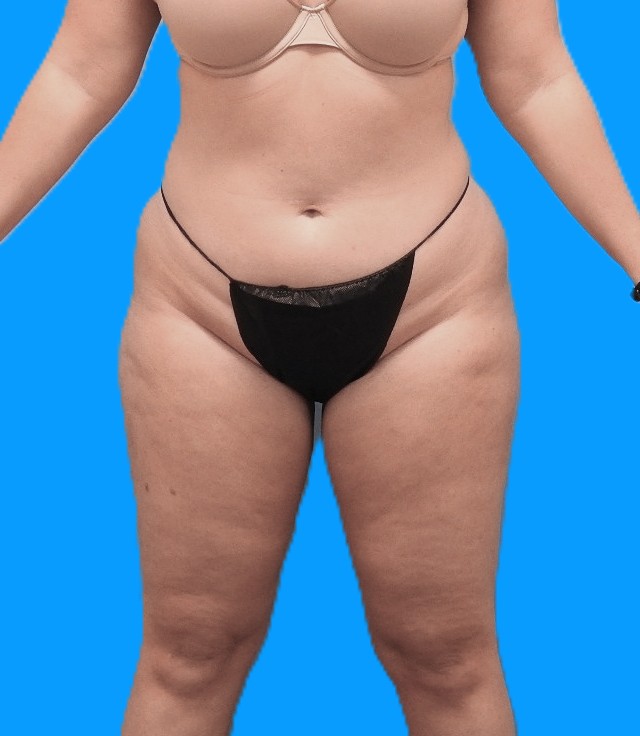 Before Image: Patient Case #0131 - front