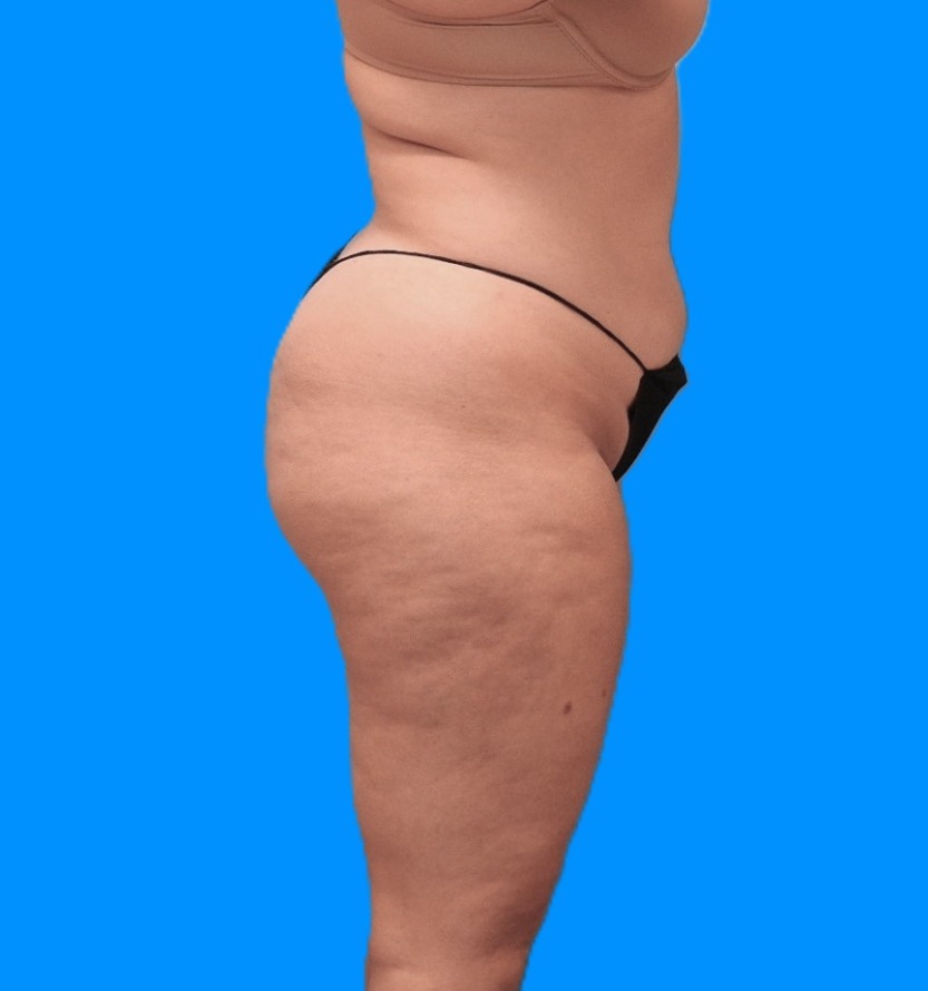 Before Image: Patient Case #0131 - right-side