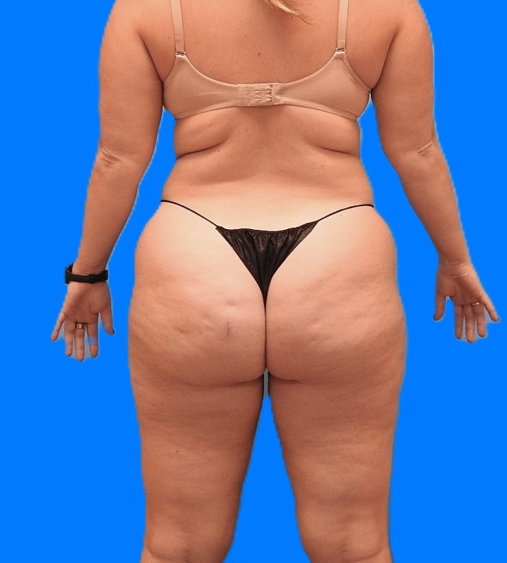 Before Image: Patient Case #0131 - back