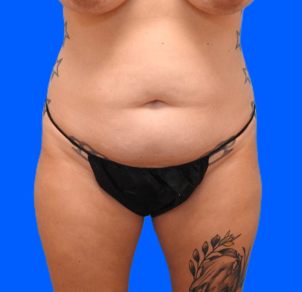 Before Image: Patient Case #0132 - front