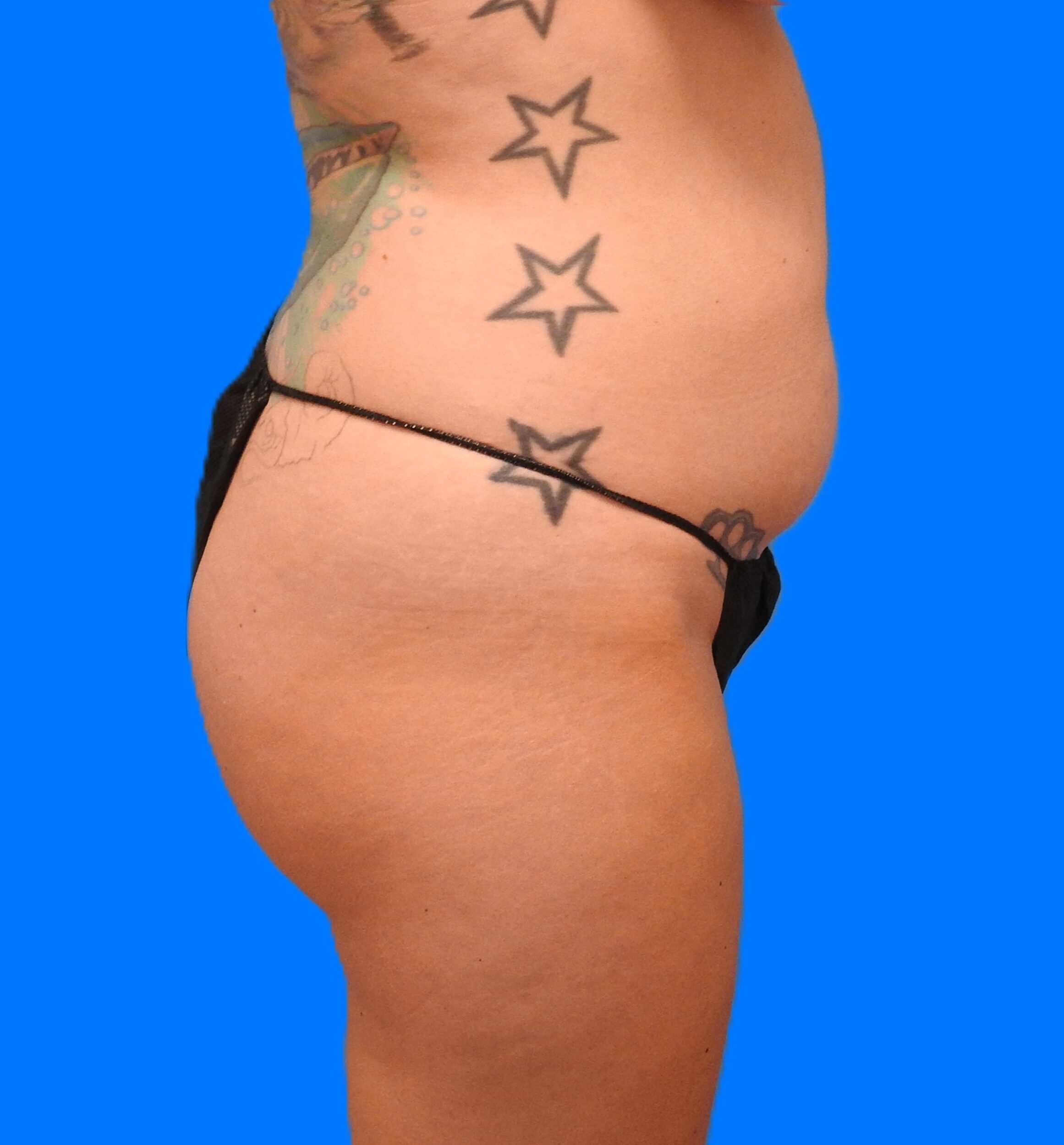 Before Image: Patient Case #0132 - right-side