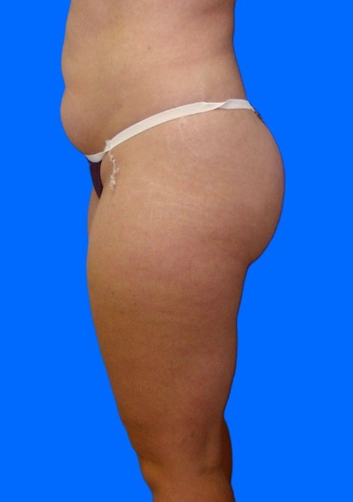 Before Image: Patient Case #0133 - left-side