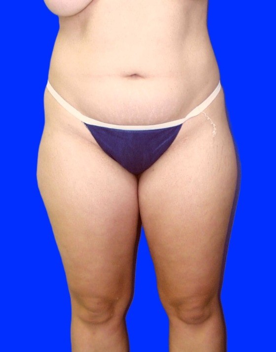 Before Image: Patient Case #0133 - front