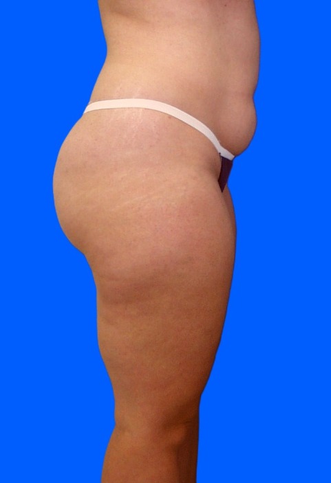 Before Image: Patient Case #0133 - right-side