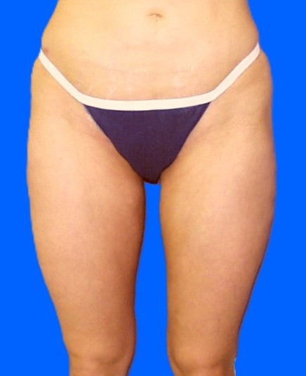 After Image: Patient Case #0134 - front