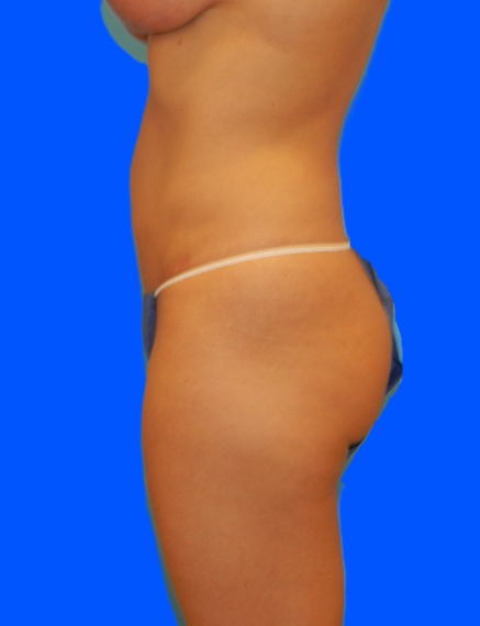 After Image: Patient Case #0134 - left-side