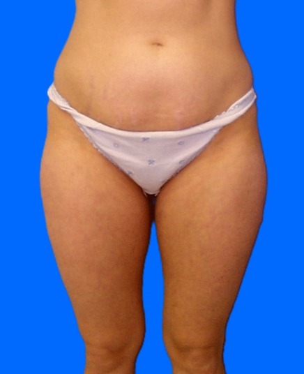 Before Image: Patient Case #0134 - front