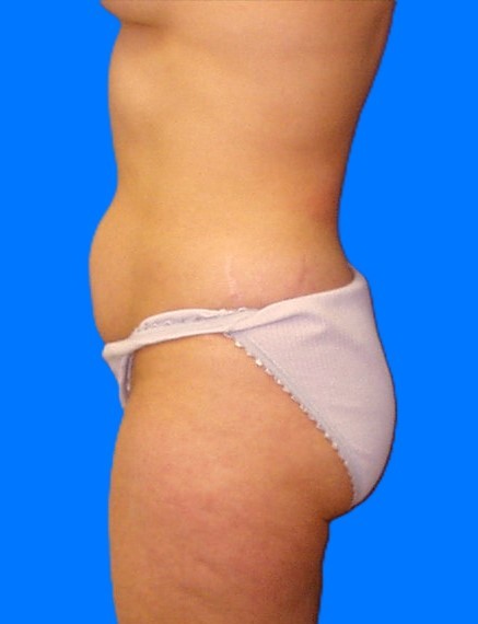 Before Image: Patient Case #0134 - left-side