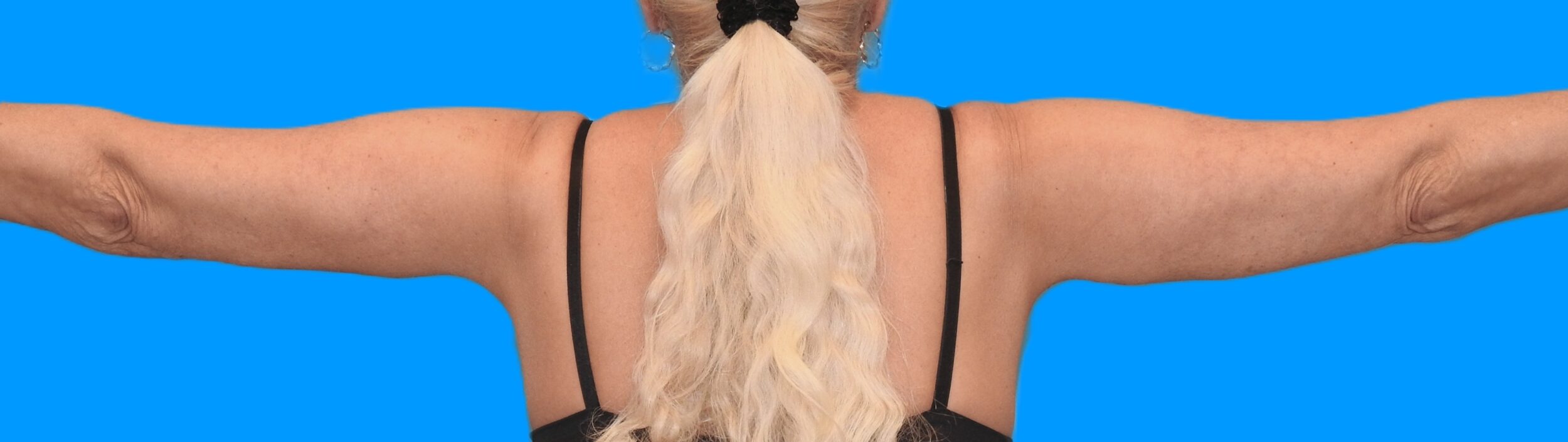 After Image: Patient Case #0135 - back