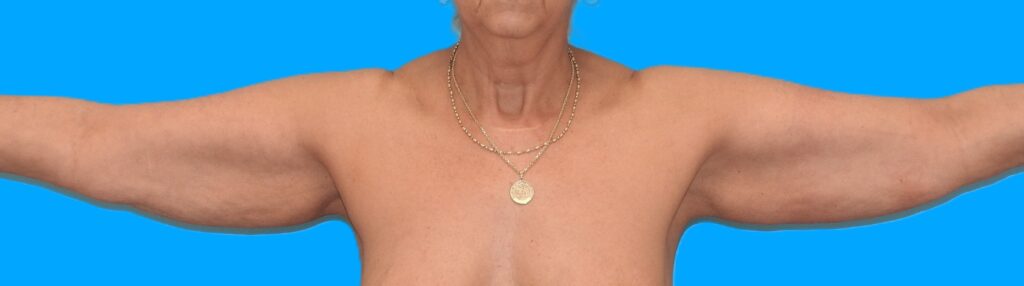 Before Image: Patient Case #0135 - front